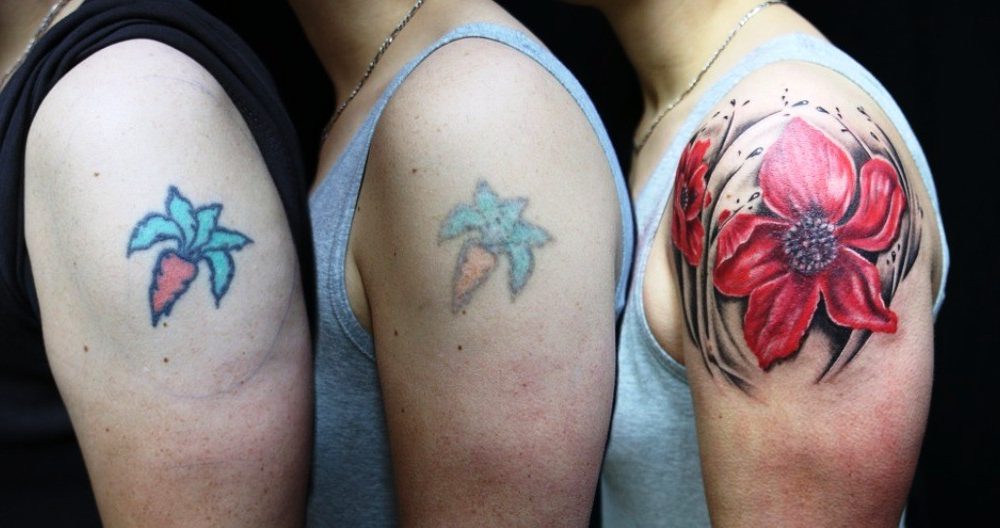 How To Remove Your Unwanted Tattoo Permanently And Safely