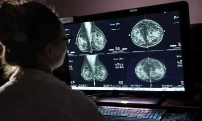 Breast Cancer Screenings Why Starting at Age 40 is Crucial for Early Detection