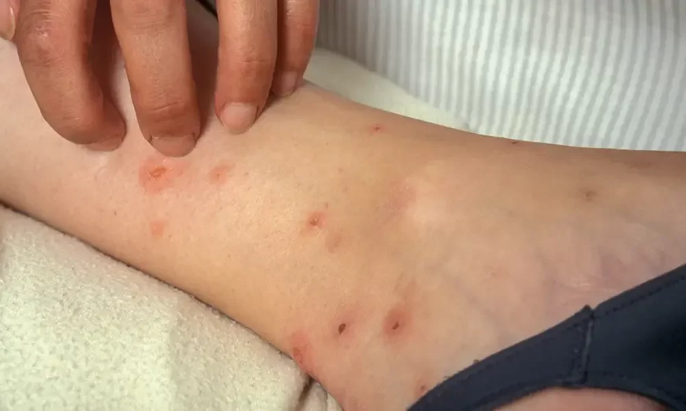 Bed Bug Bites Treatment: Learn How To Get Rid Of Itchy Bed Bug Bites ...