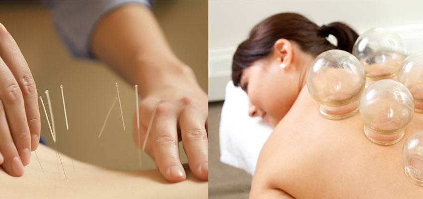 Dry Needling And Cupping Therapy
