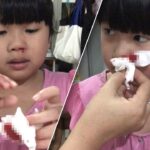 Children in Chiang Mai Suffering from Nose Bleeds