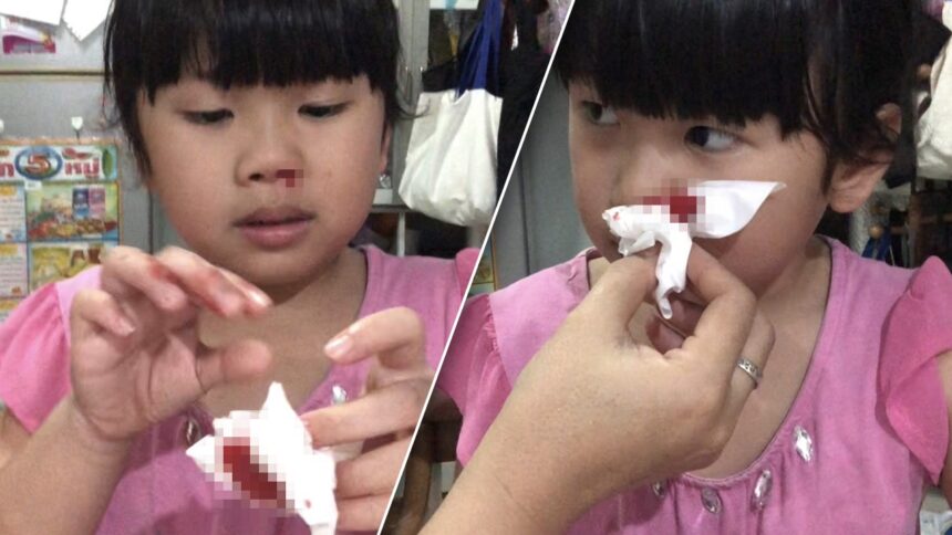 Children in Chiang Mai Suffering from Nose Bleeds